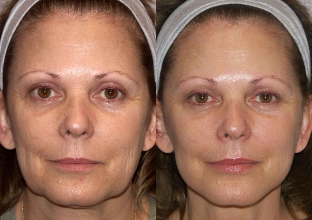 Botox for Mid/Lower Face and Neck